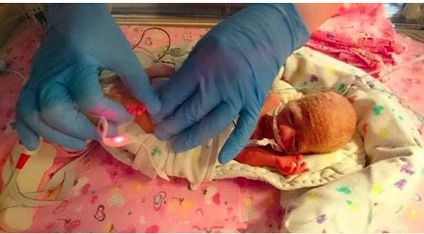 早产将近3个月，新生儿体重仅0.99斤却仍顽强存活，不禁让人感叹