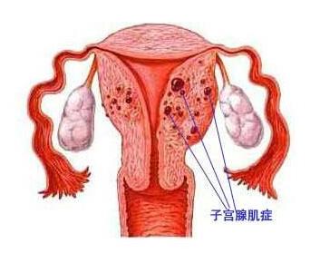 痛经几十年忽然好了咋回事,经量增多经期延长见于哪些病