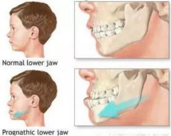 武汉大学口腔医院隐形牙齿矫正,武汉成人隐形牙齿矫正龅牙
