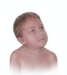 婴儿为何肌性斜颈会导致睡斜头,宝宝的头总是歪向一边