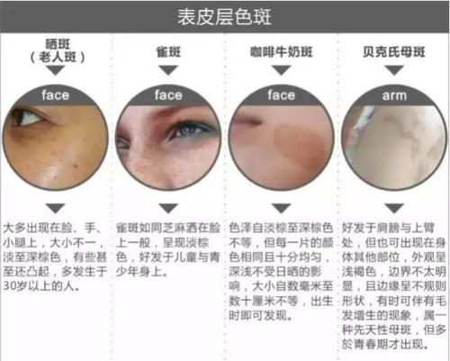 青褐斑怎么内调最好,褐青色斑怎么护理