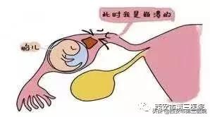【警惕“异位妊娠”】跑偏了的“受精卵”