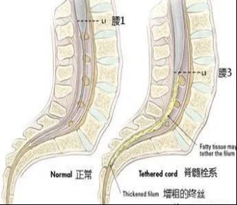 脊髓栓系综合征如何缓解,做了脊髓栓系综合征会有后遗症吗