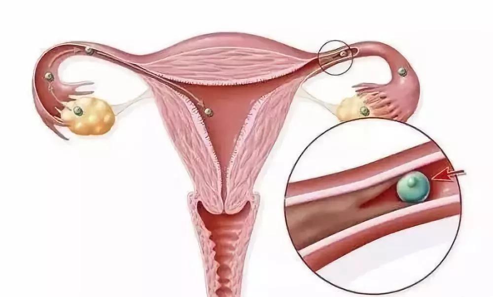 输卵管通而不畅不怀孕怎么办,输卵管通怀不上怎么回事