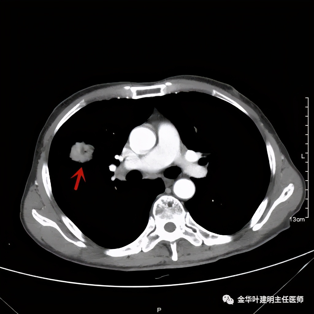 左肺占位被安排穿刺活检是肺癌吗,肺癌肺部穿刺有什么危险