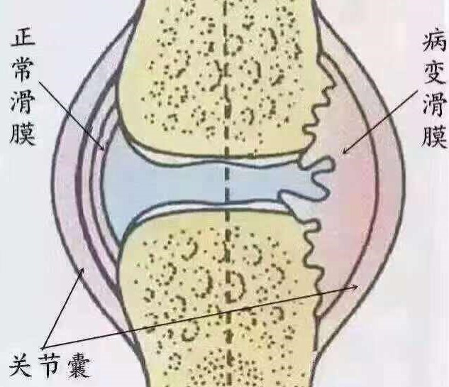 吹空调胳膊关节疼痛怎么解决,空调吹了关节受凉酸痛怎么办