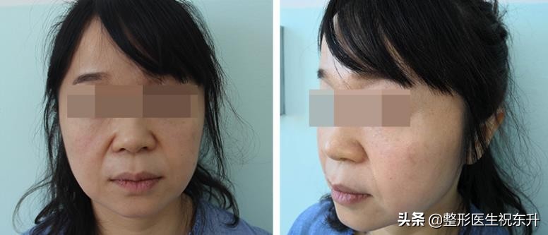 40岁-50岁上下，对抗面部松弛这些“弯路”请绕行？