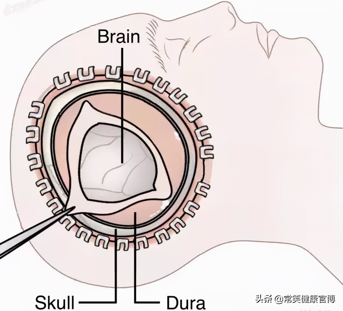 去骨瓣减压术后脑梗如何处理,去骨瓣减压术头骨如何恢复
