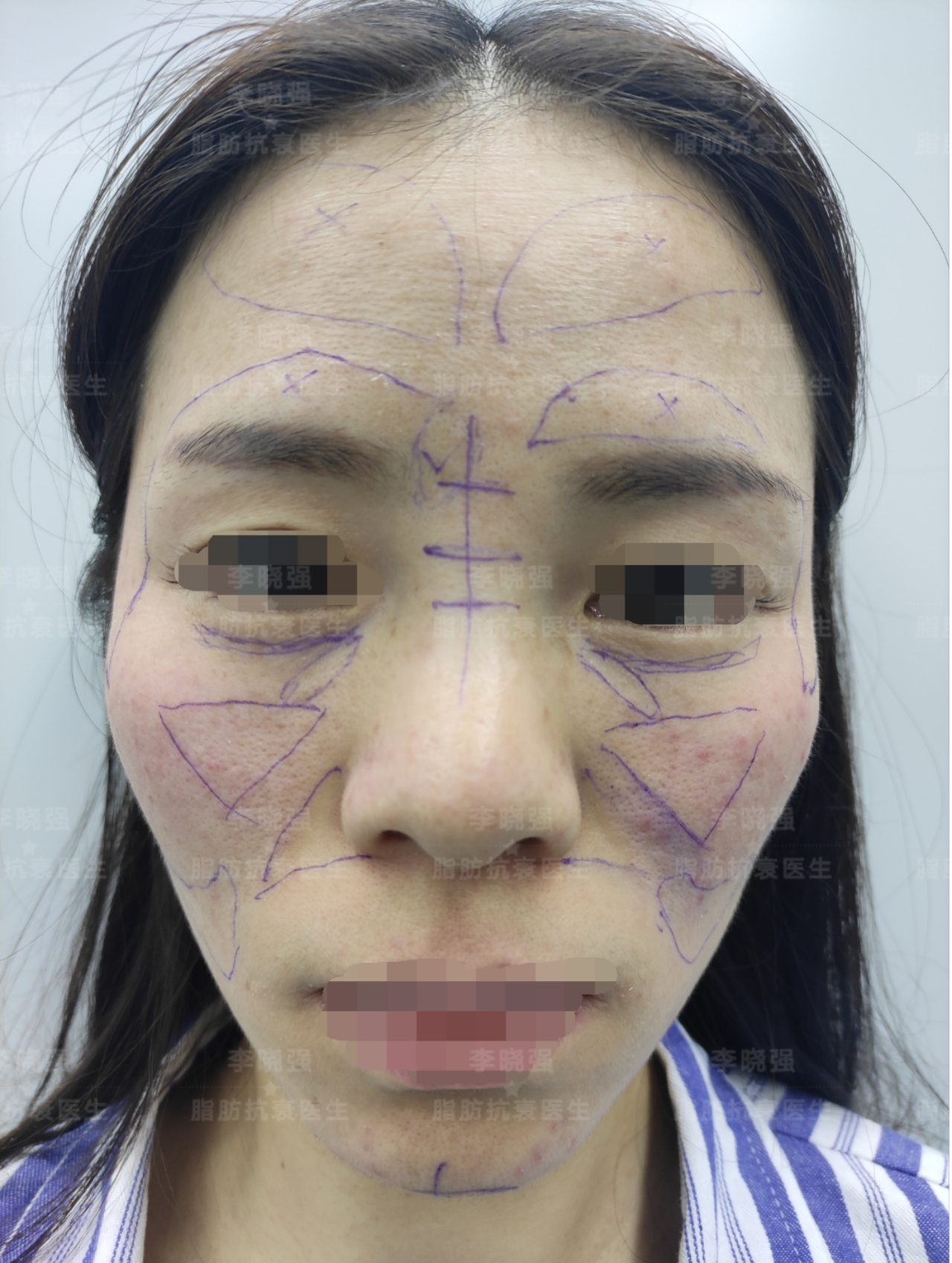 面部精雕收颧骨手法,颧骨高太阳穴凹陷怎么整形