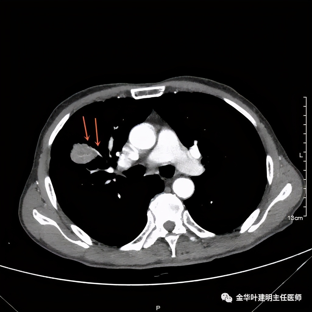 左肺占位被安排穿刺活检是肺癌吗,肺癌肺部穿刺有什么危险