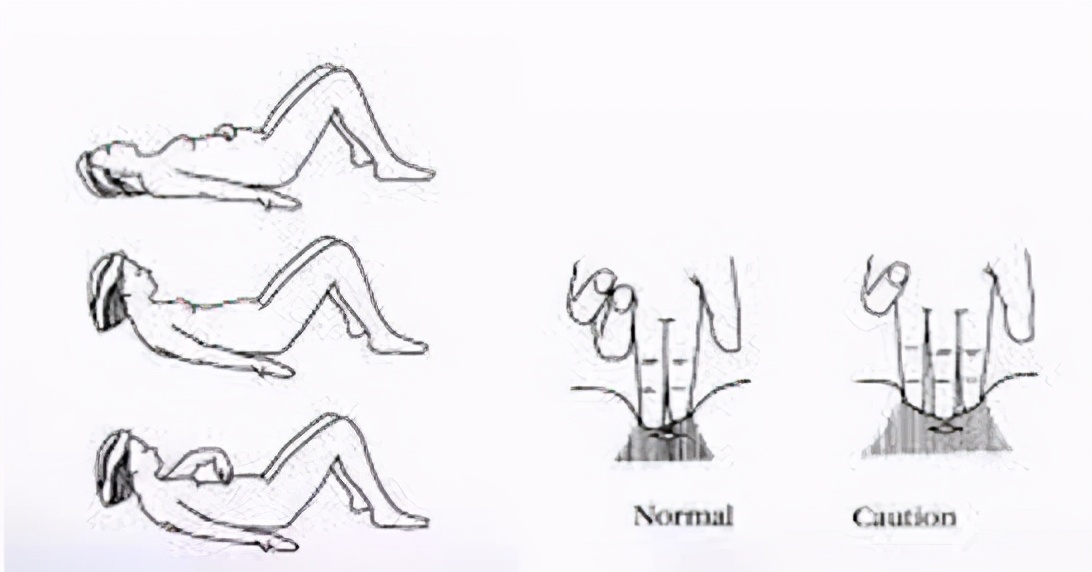 产后妊娠纹肚皮松怎么解决,产后肚子松垮小腹突出