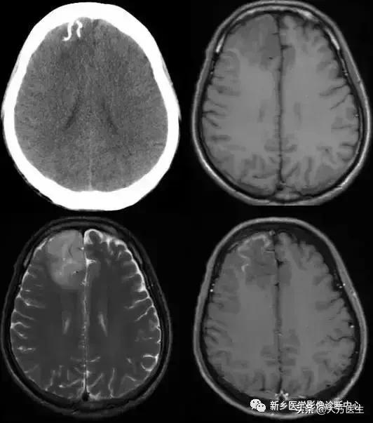 钙化灶是良性肿瘤的可能性大吗,颅内肿瘤钙化发生率最高