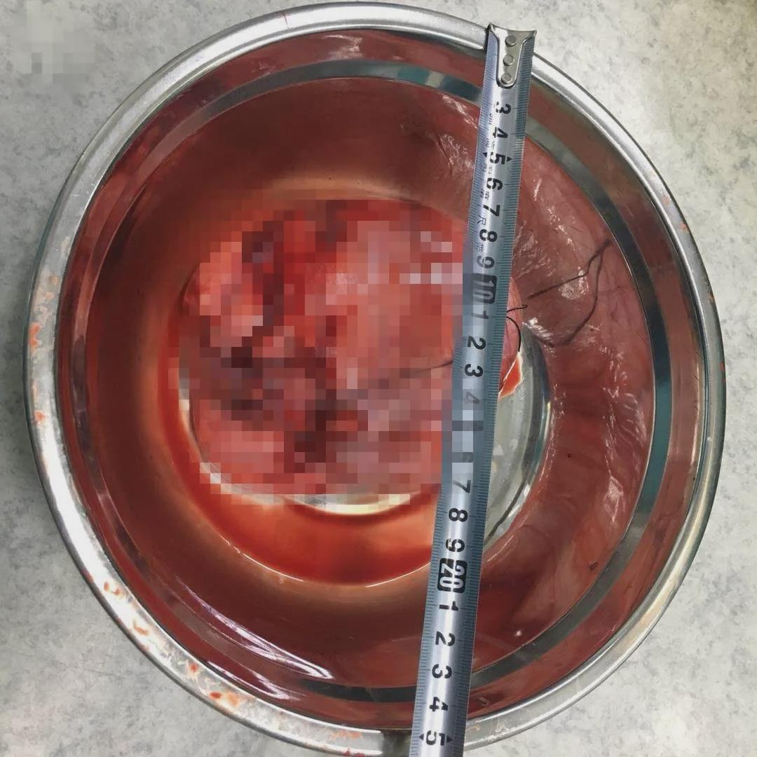 剖腹产把卵巢囊肿切除能喂母乳吗,剖宫产加卵巢囊肿手术时间多久