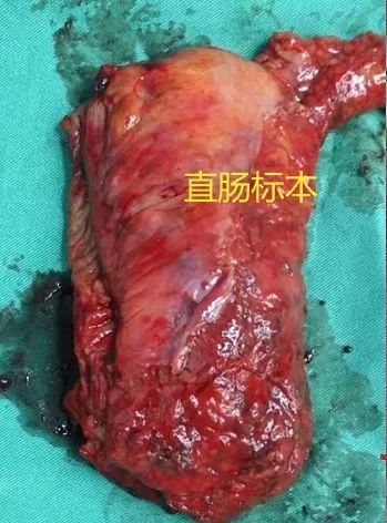 县中医院首例腹腔镜手术圆满成功,直肠癌腹腔镜手术成功案例