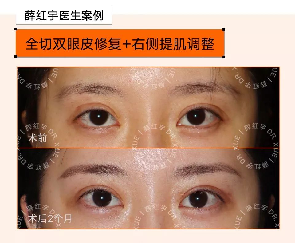 双眼皮整形修复,潘贰双眼皮修复