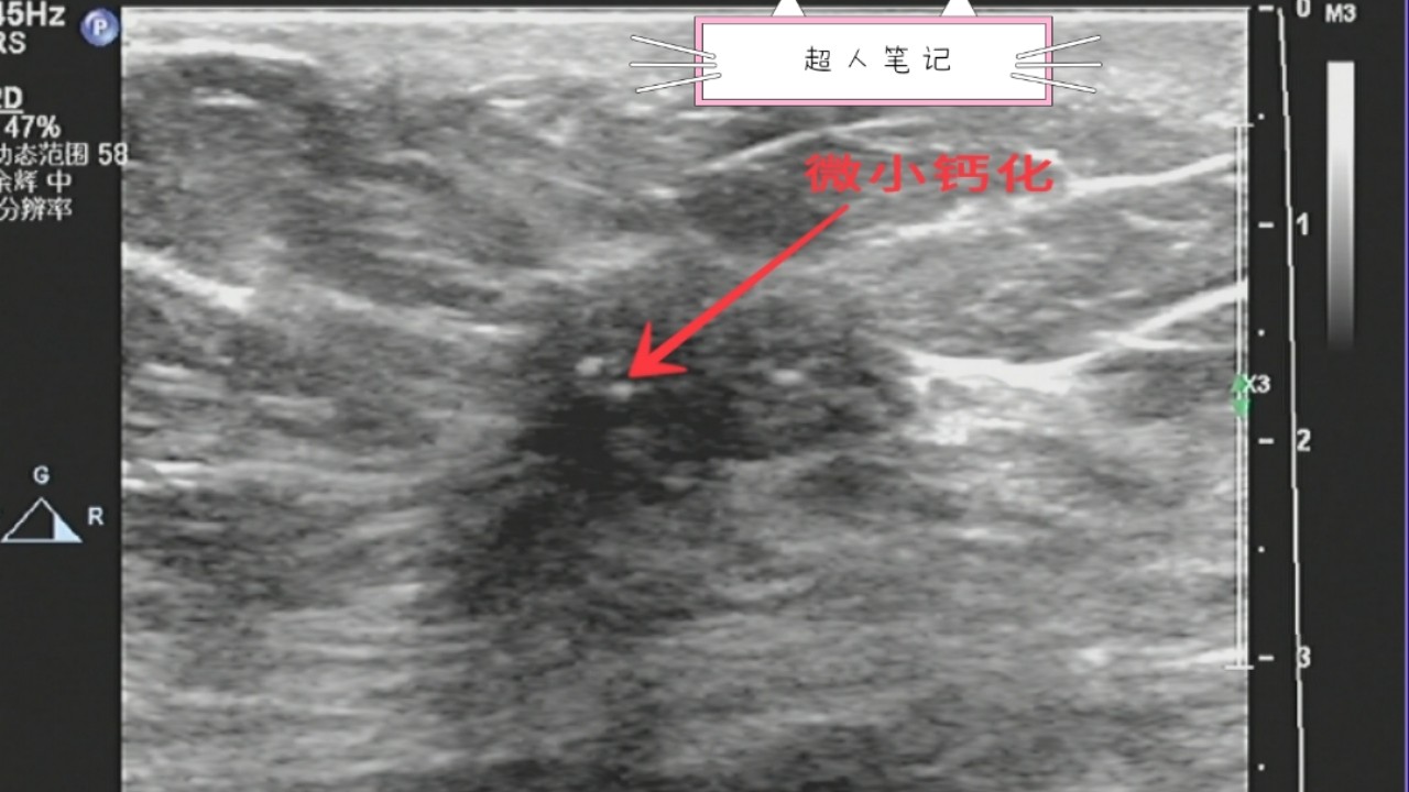 乳腺癌彩超能看出淋巴异常吗,乳腺结节和乳腺癌彩超区别