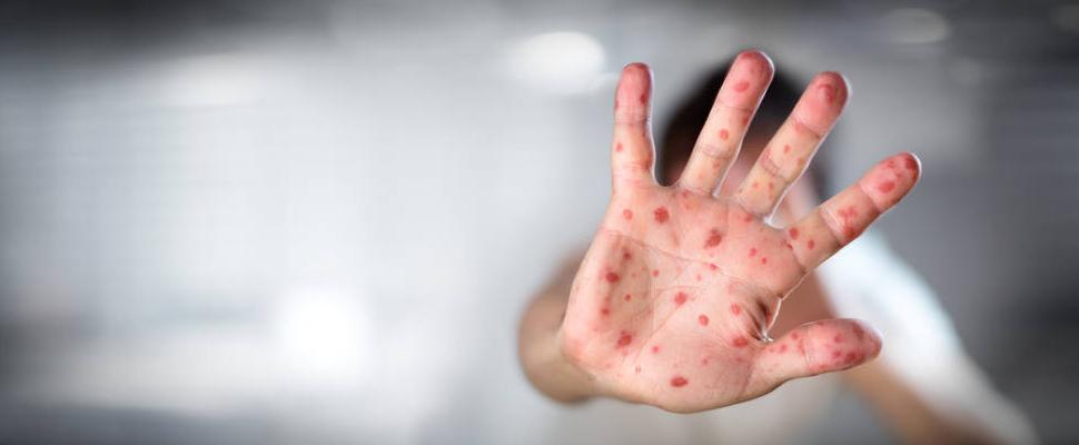 小孩没有得手足口病脱甲怎么回事,5岁小孩突然脱指甲怎么回事