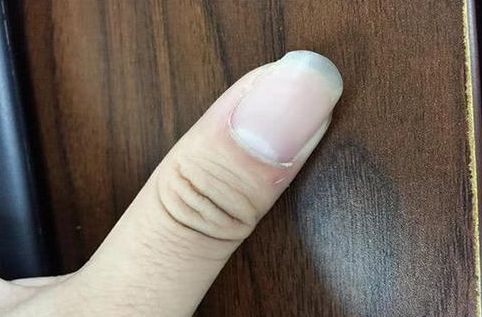 指甲表面长了竖纹，很多人恐慌自己身体不好？看完终于放心了