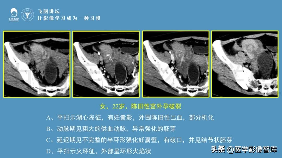 子宫解剖结构输卵管和卵巢位置,子宫附件ct影像学正常解剖表现