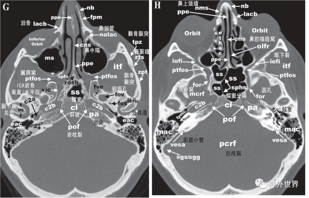 颅底骨折合并脑脊液漏伤情鉴定,颅底骨折伴脑脊液漏右眼眶骨折