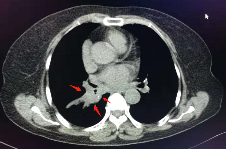 与肺癌病人一起生活需要注意什么,与肺癌抗战的第七个月