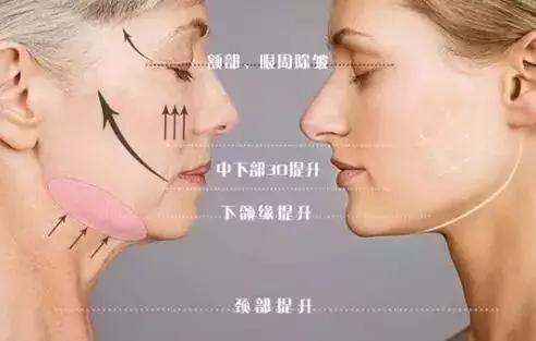 无针逆龄线雕全脸抗衰,抗衰线雕怎么做