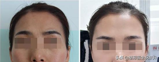 自体脂肪丰太阳穴多久才能恢复,自体脂肪丰太阳穴多久恢复正常