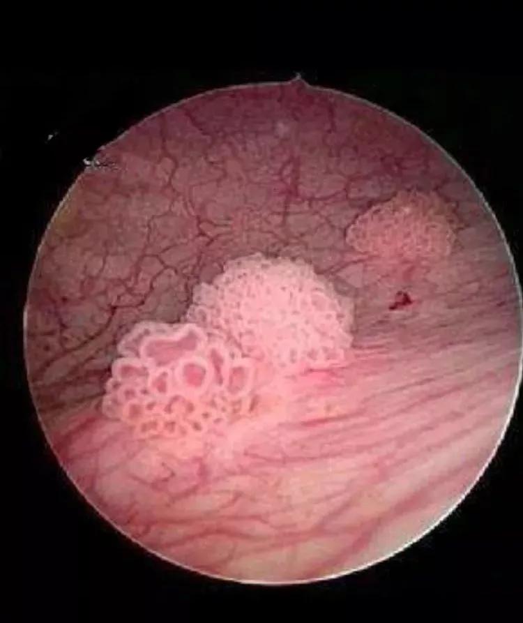 膀胱有肿瘤一定是癌症吗,通俗易懂讲解膀胱肿瘤