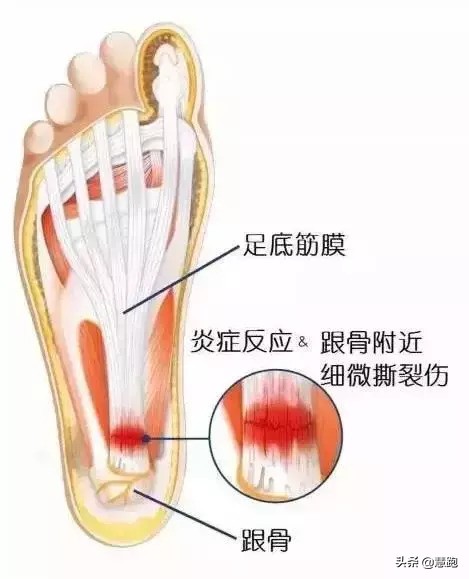 治疗足底筋膜炎最好的方法,足底筋膜炎治疗的正确方法