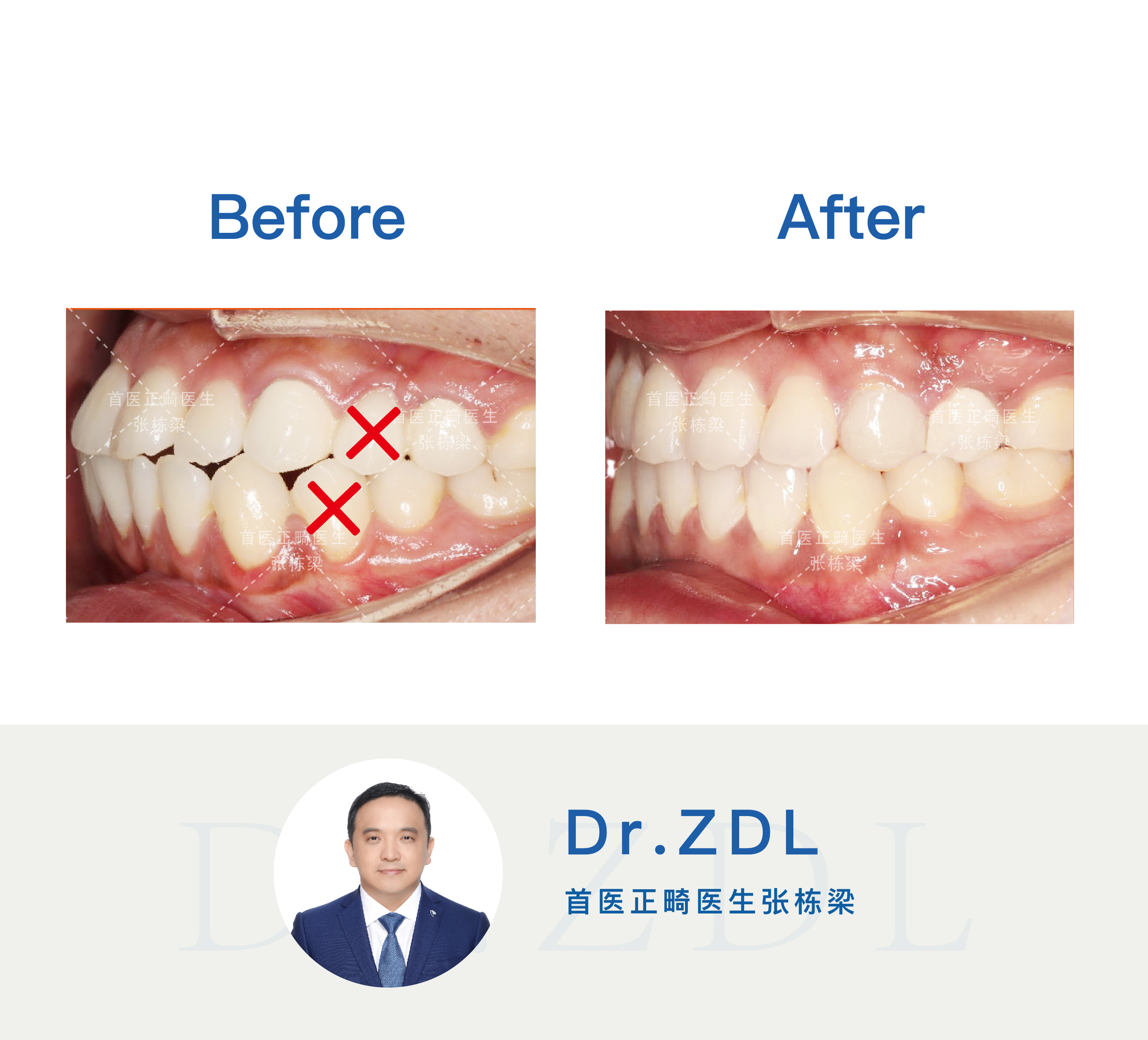 做了烤瓷桥还能正颌吗,做了烤瓷桥还能做钢牙吗
