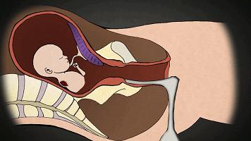 堕胎到底有没有恶果,堕胎真的那么可怕吗