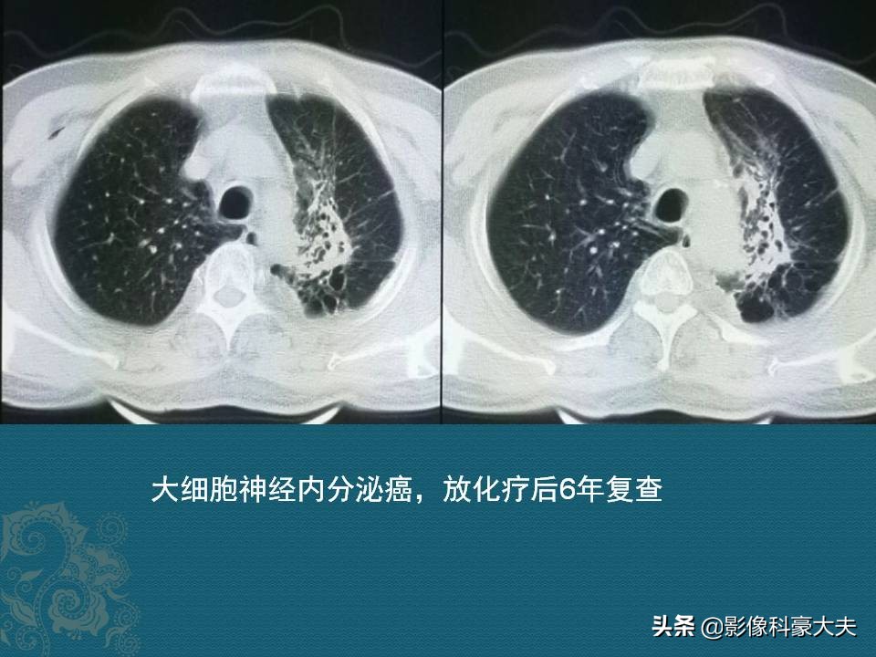 这5种癌一发现就是晚期,第一例癌症患者治愈
