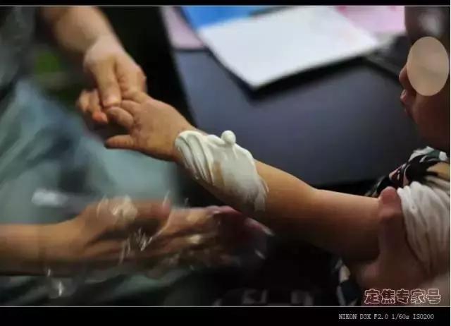 湿疹反反复复如何治疗不用激素药,孕妈妈得了湿疹之后应当如何治疗