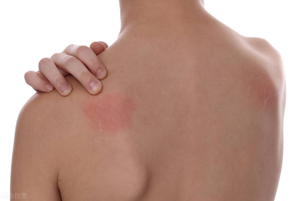 春季皮肤过敏发红发痒刺痛,换季皮肤过敏刺痛怎么办