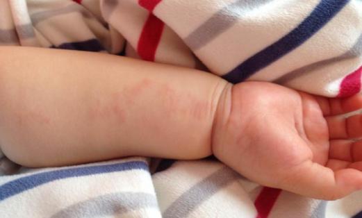 白癜风一年没扩散还一直在恢复,三个月可以治愈白癜风吗