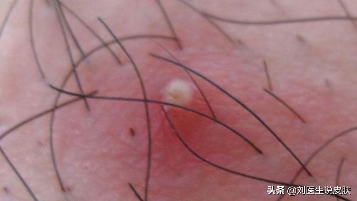 前胸后背长痘毛囊炎,前胸后背痤疮和毛囊炎的药