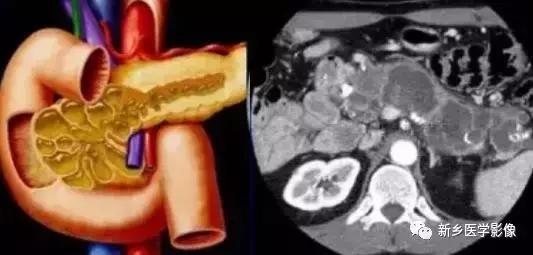 18种胰腺肿瘤，为什么我就知道两种