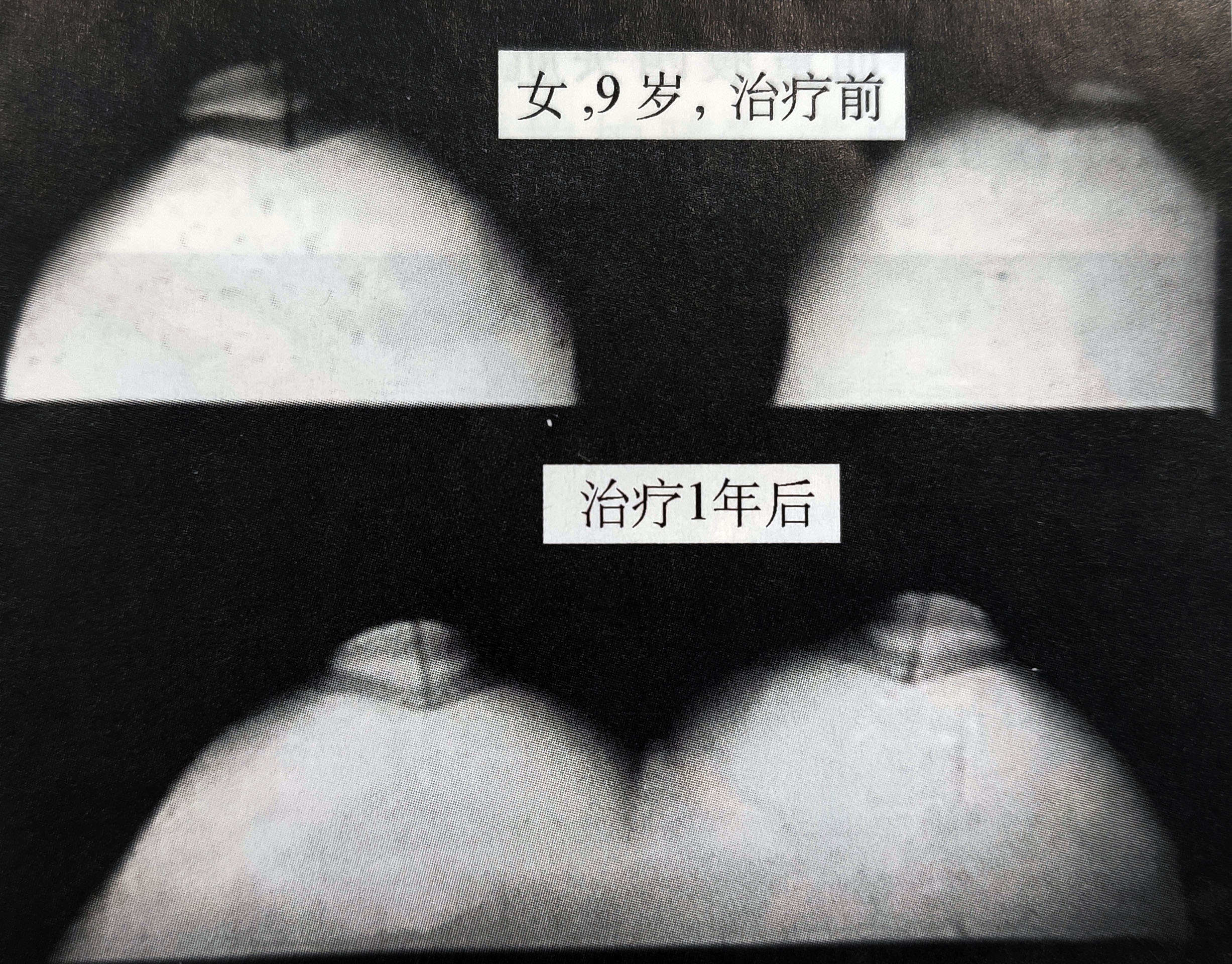 髌骨软化症的病因诊断和治疗探索,正确认识膝关节