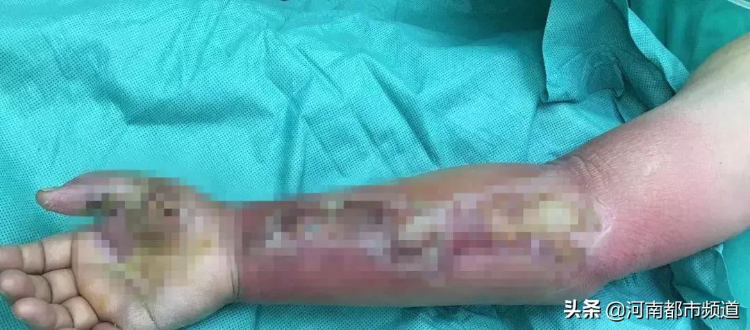 男子被虾刺刺伤伤残能赔付吗,一男子被虾刺身亡