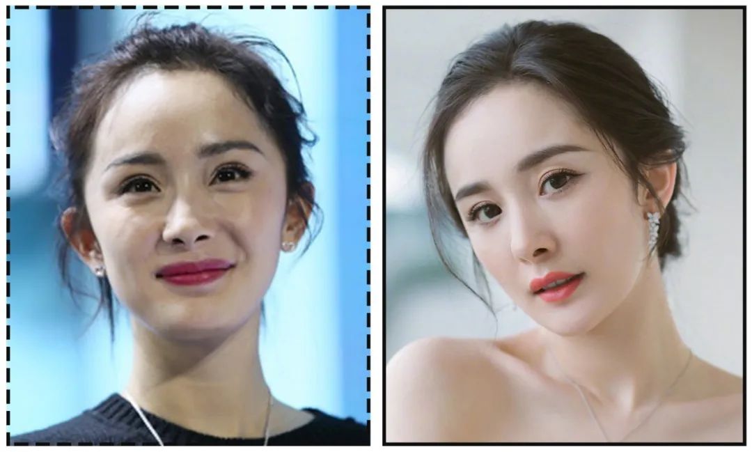 娄艺潇填充脂肪前后对比,娄艺潇填充前后对比