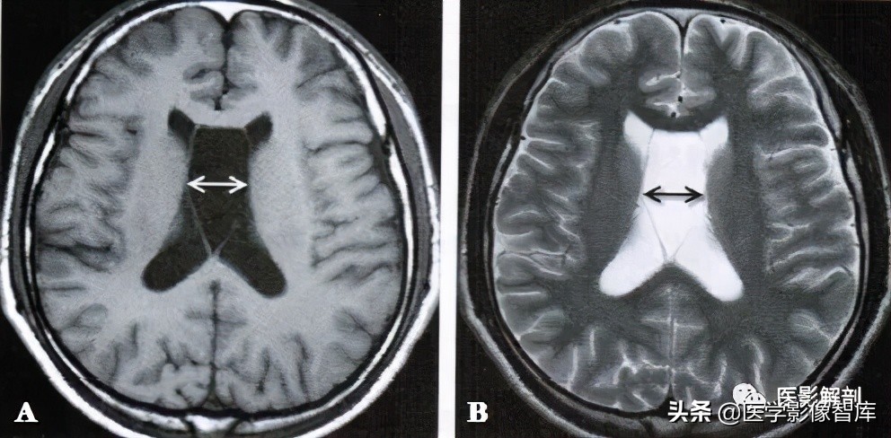胎儿透明隔间腔及vergae腔,透明隔间腔及vergae腔需要治疗吗