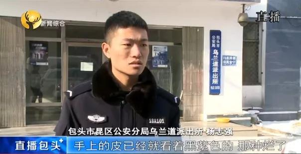 内蒙古一男子四肢严重冻伤需手术,急寻家人