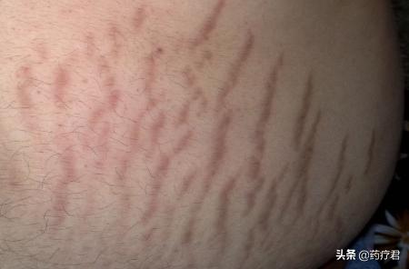 灏忎紮鑳屼笂闀挎枒椹嚎,14宀佺敺瀛╄儗涓婃儕鐜版枒椹嚎