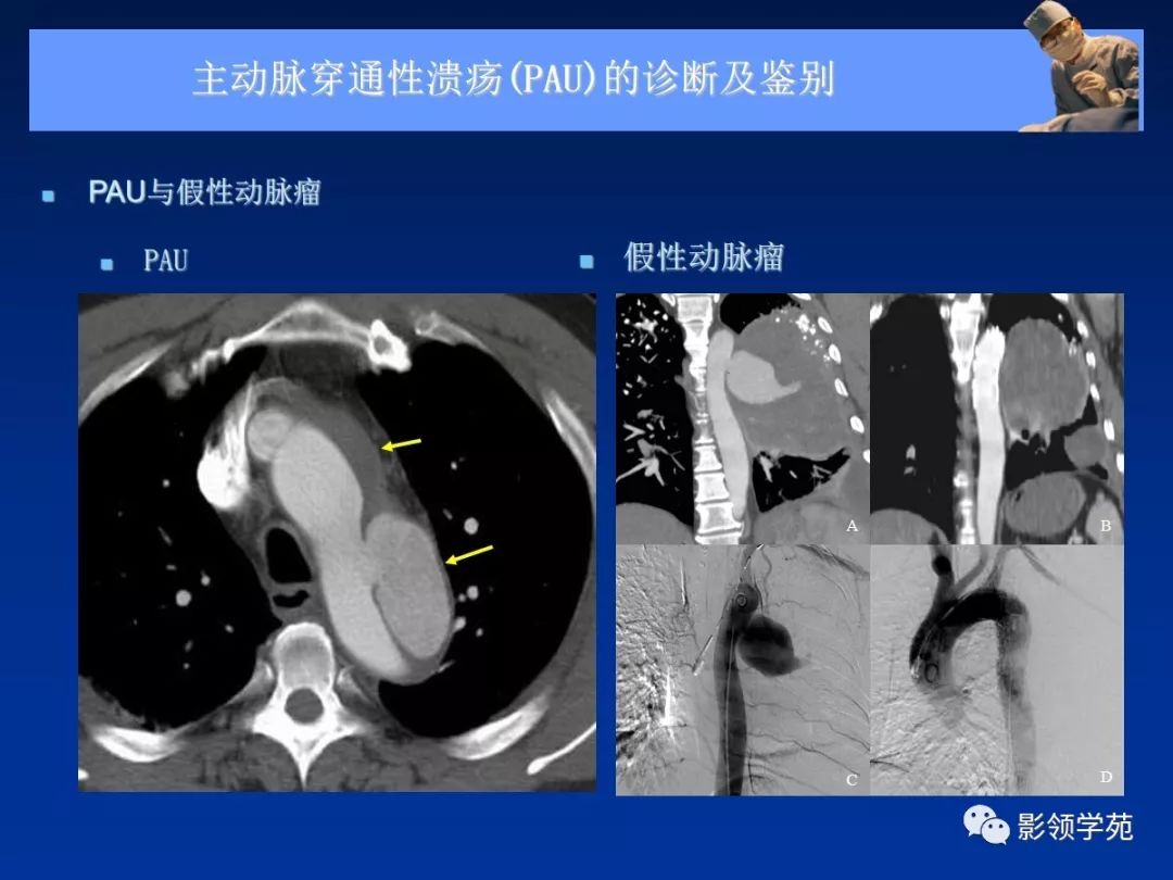 主动脉夹层壁间血肿如何鉴别,主动脉夹层血肿溃疡