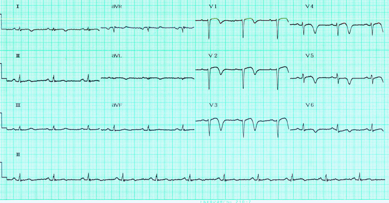 急性心包填塞影响心脏健康,了解掌握病因,探索治疗方法