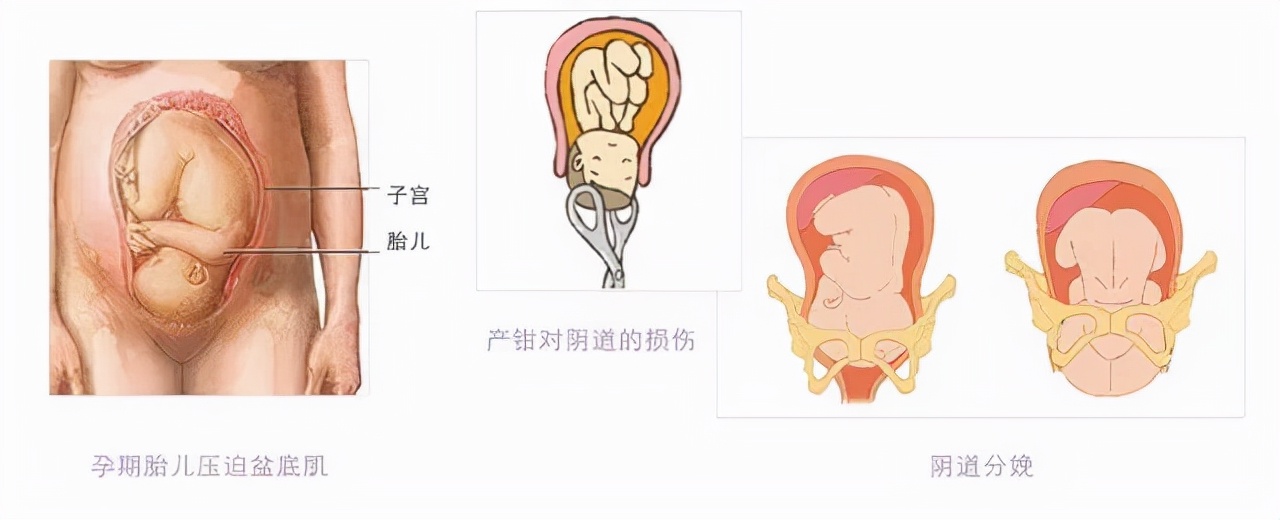 盆底康复治疗多少钱,盆底康复治疗过程图解