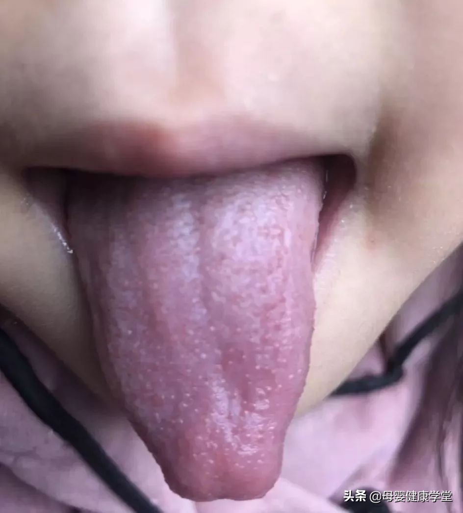 宝宝舌头尖原来是它引起的,快来看看你的宝宝中招了吗?