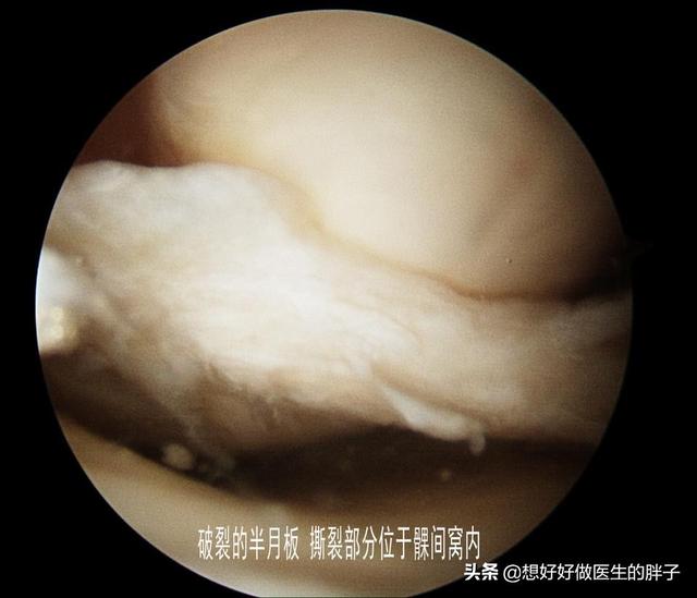 半月板撕裂关节镜手术后能痊愈吗,半月板撕裂关节镜手术后恢复时间
