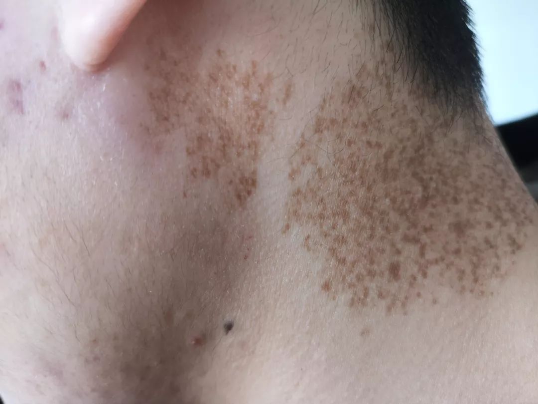 雀斑样痣是雀斑的一种吗,雀斑痣和健康痣有什么区别