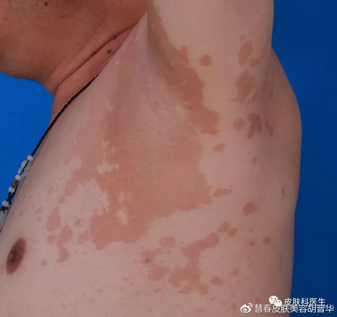 是湿疹或癣医生一眼就能辨出来吗,是不是体癣怎么检查